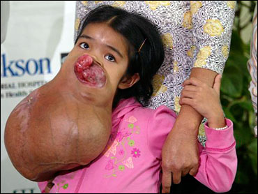 Girl Awaits Pound Facial Tumor Removal CBS News