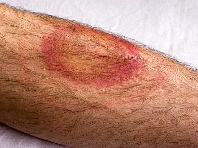 Lyme Disease Symptoms Bulls Eye Rash Isnt Whole Story Cbs News 7268