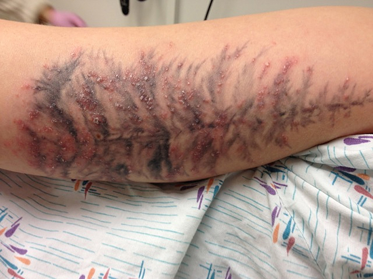 Tattoo staph infection pictures