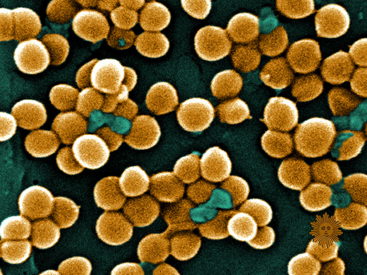 Superbugs: A Ticking Time Bomb - CBS News