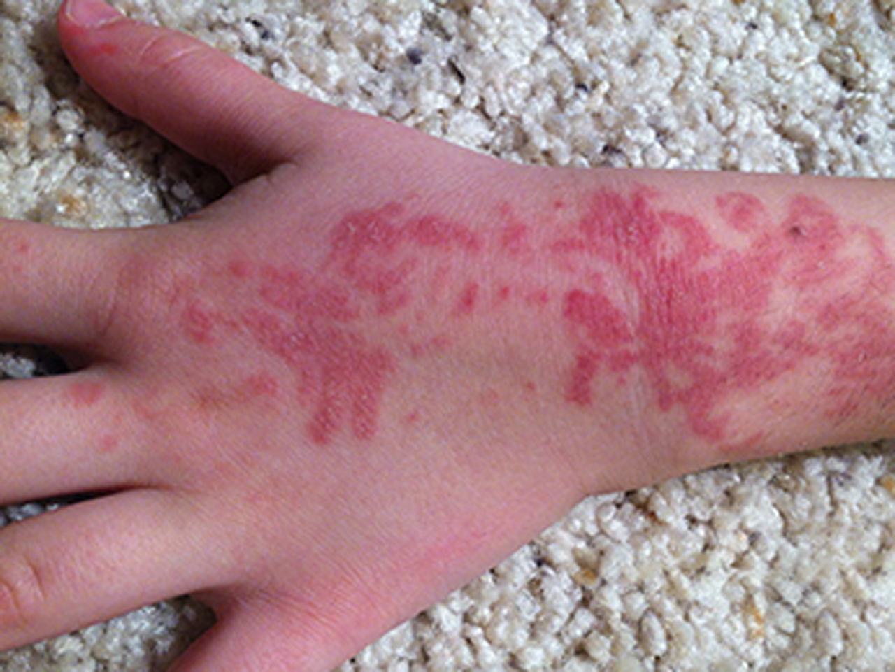 Temporary tattoos may cause long-lasting allergic reaction, FDA warns - CBS  News
