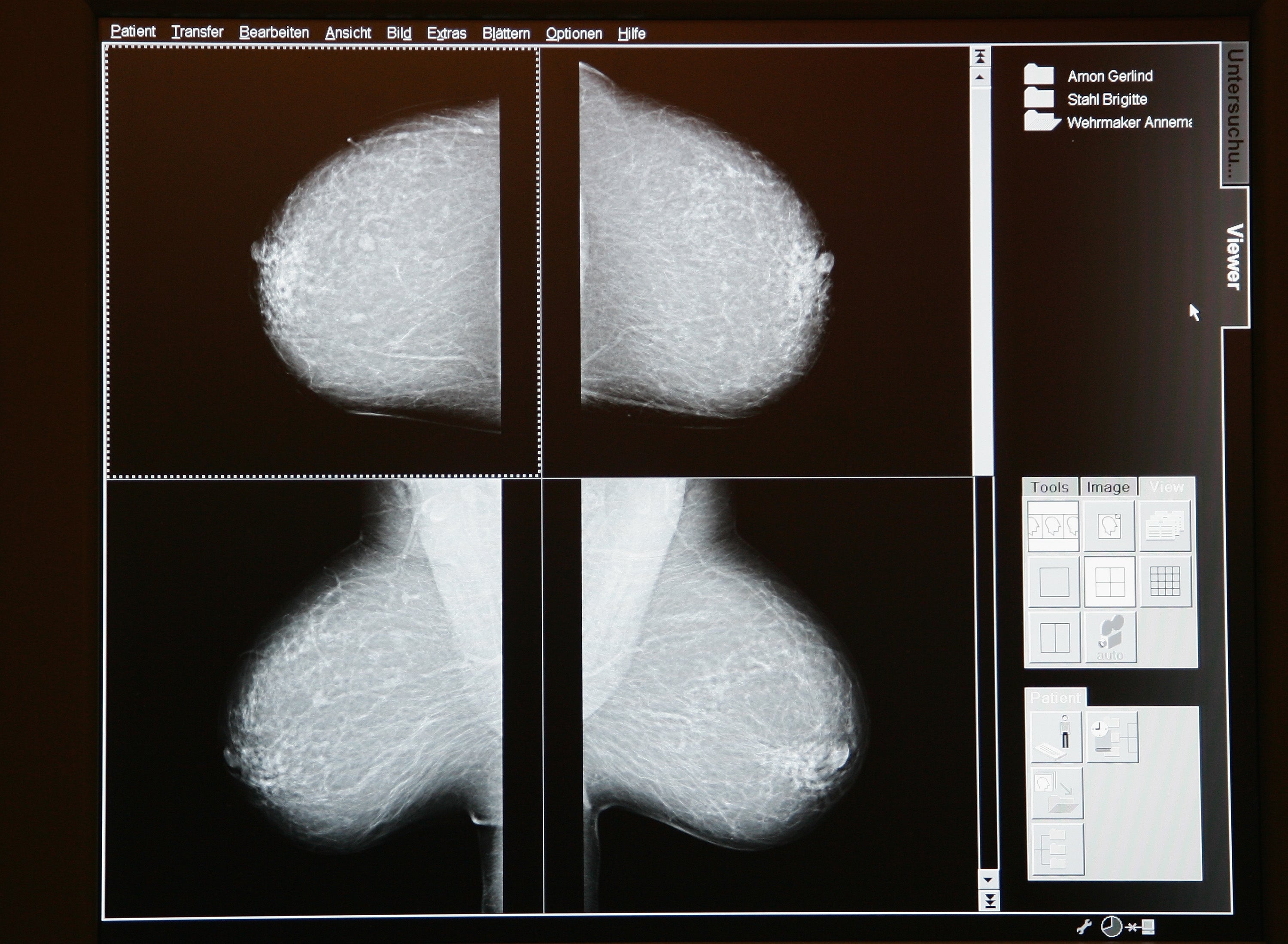 Persistent pain a problem year after breast cancer surgery CBS News