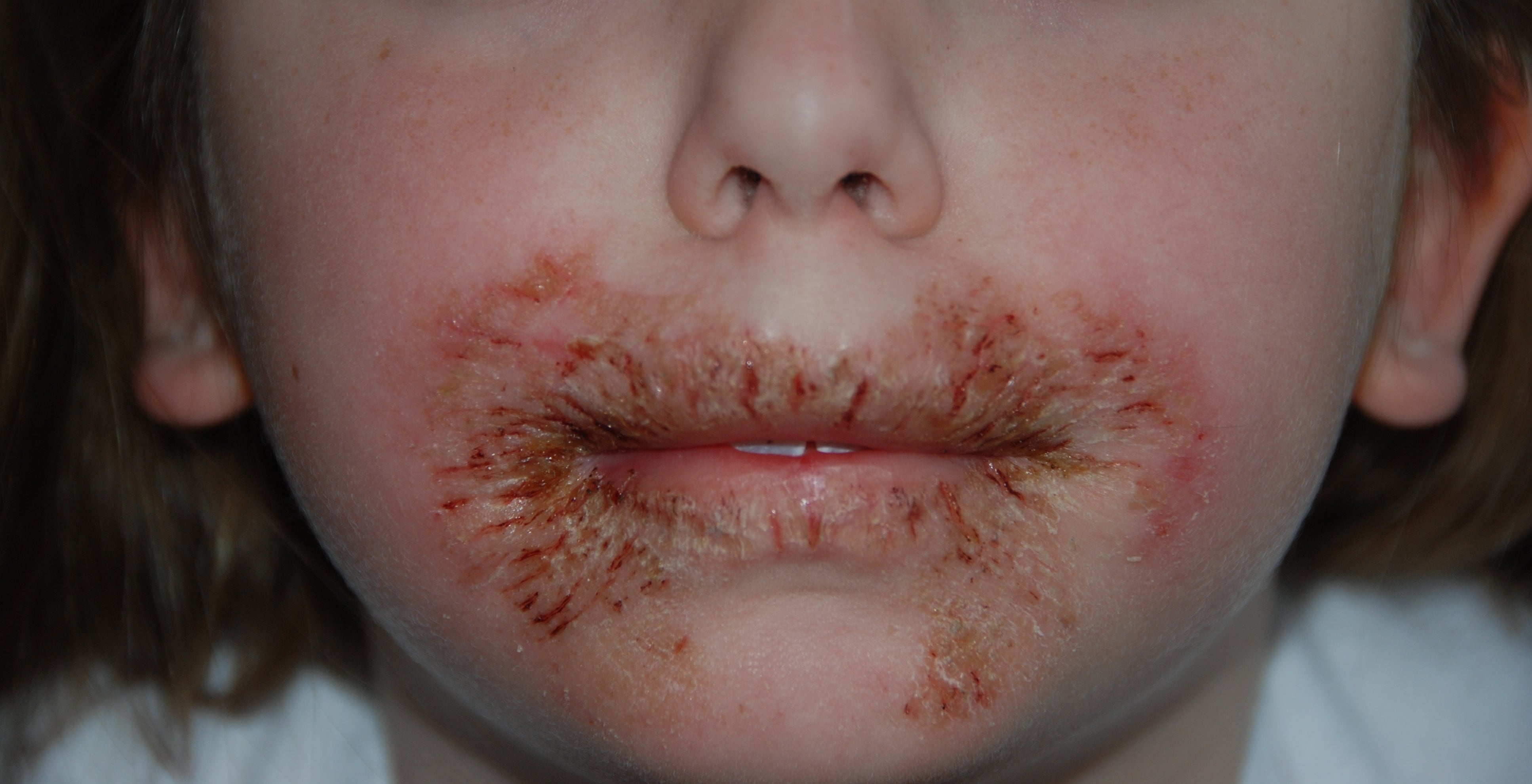 allergy rashes in children