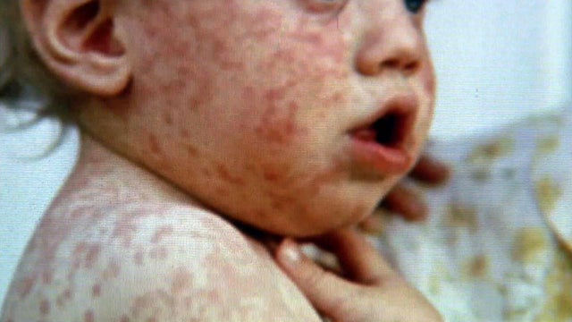 measles rash face