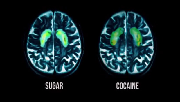 fed-up-sugar-cocaine-brain-scan-620.jpg 