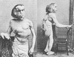 joseph-merrick-elephant-man-1889-british-medical-journal-c-244.jpg 