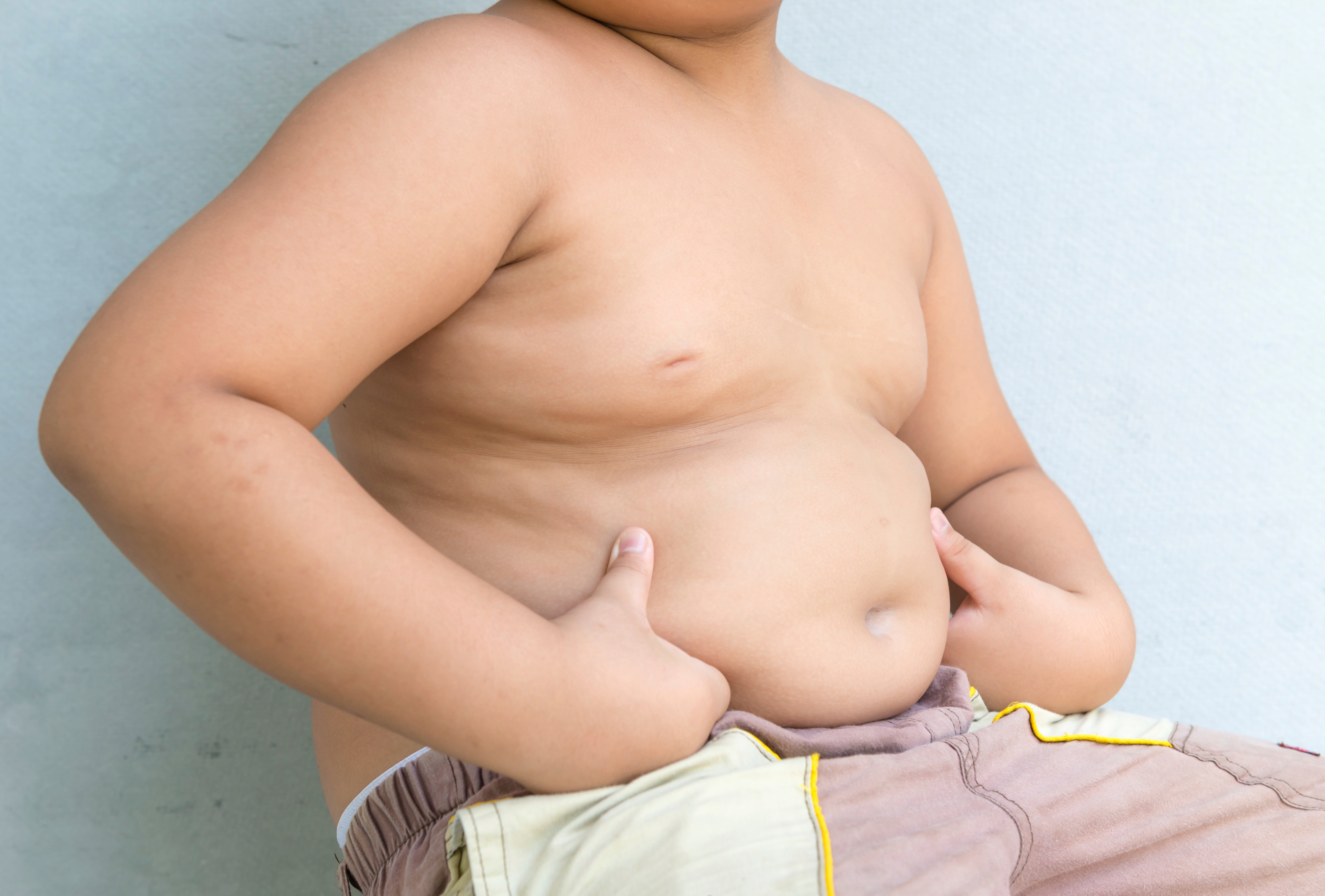 obesity in children