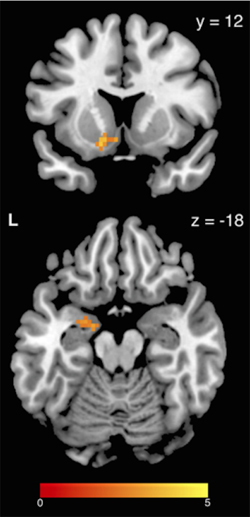 brain-scan-stress-eating-250w.jpg 