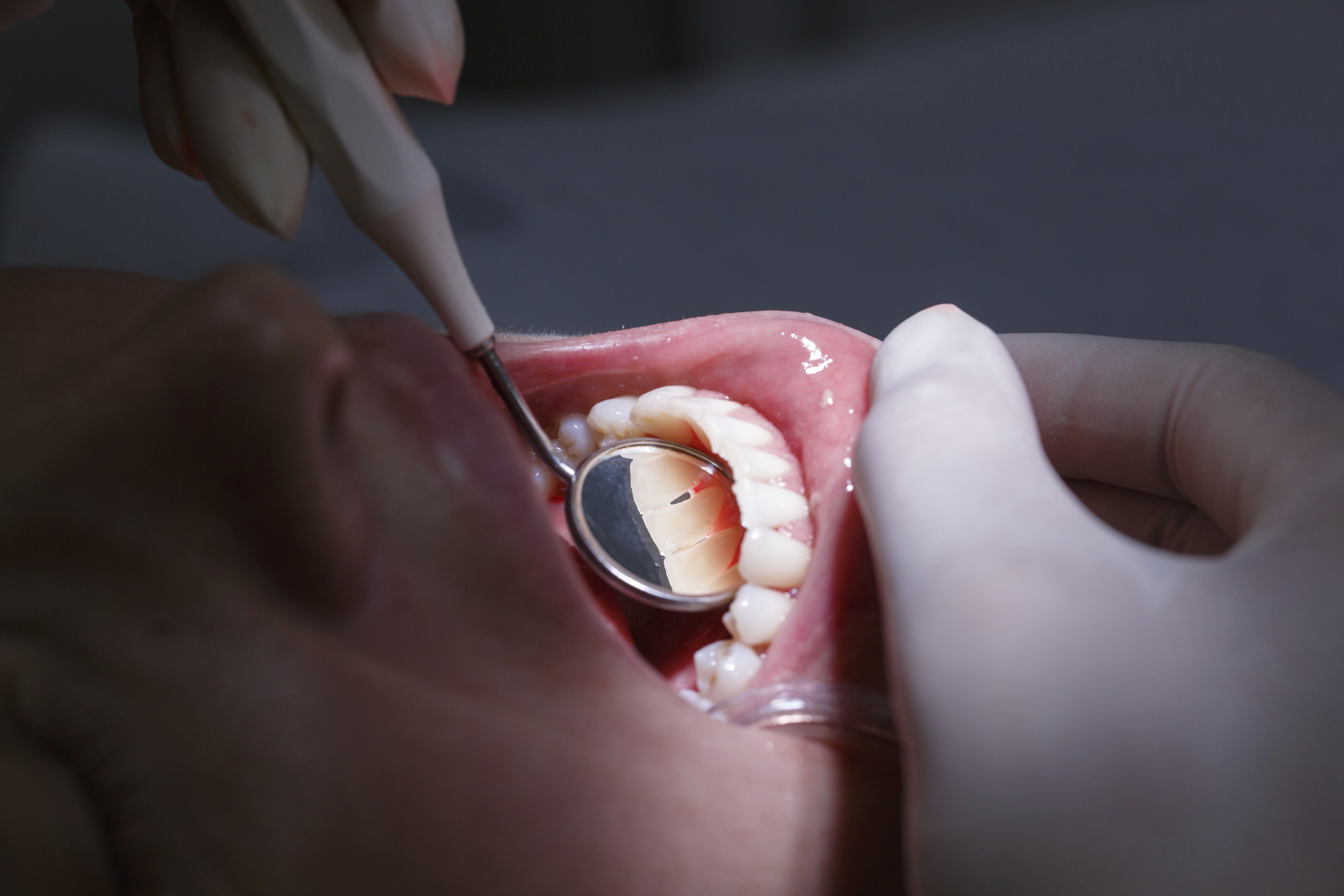 Can teeth repair themselves without fillings? - CBS News