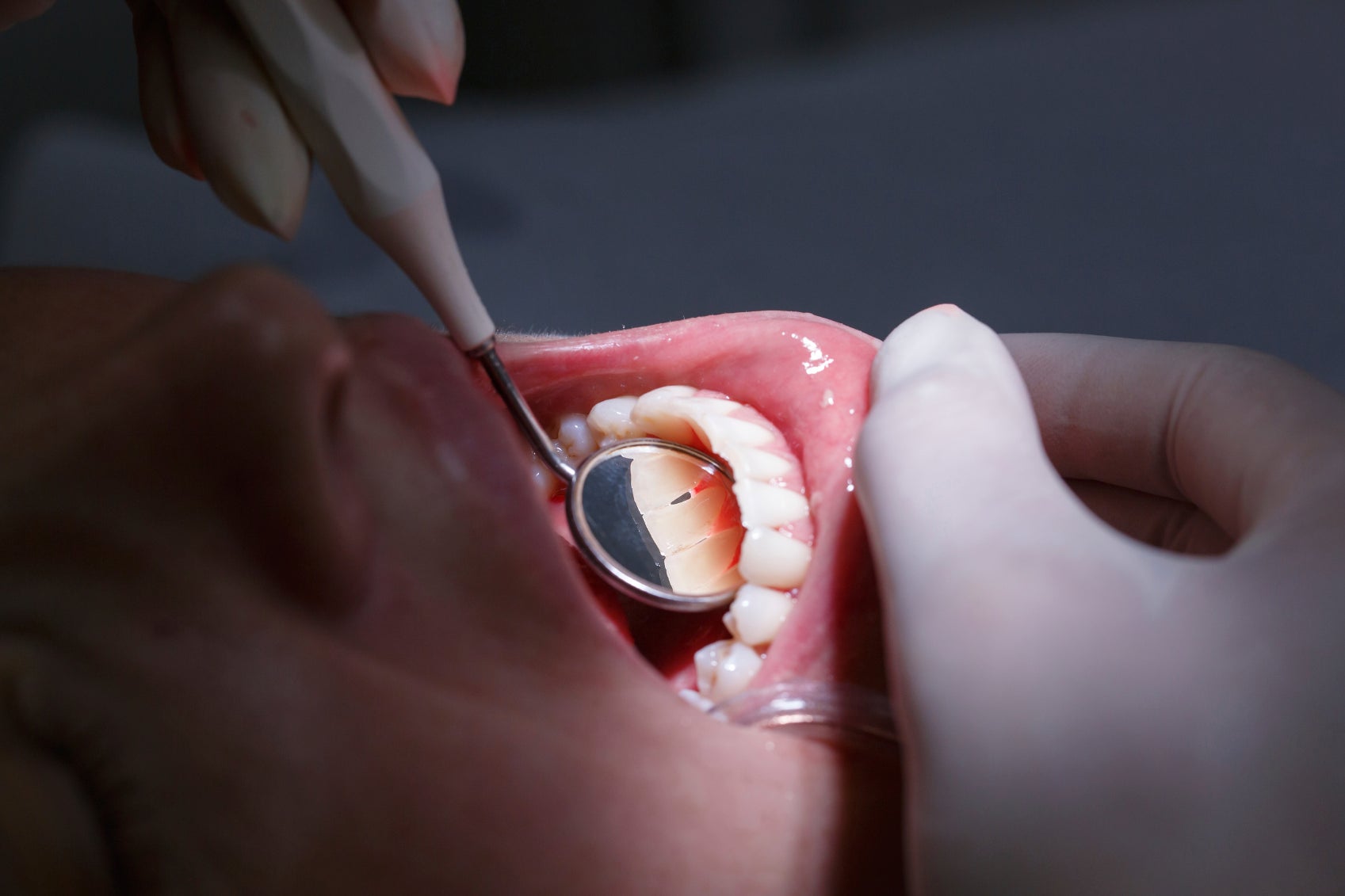 Drug Helps Teeth Repair Themselves