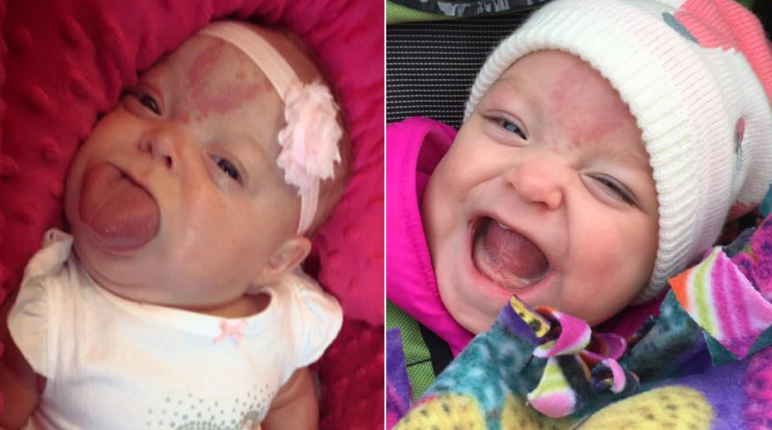 Baby born with adult-sized tongue can't stop smiling after life-changing  surgery - CBS News