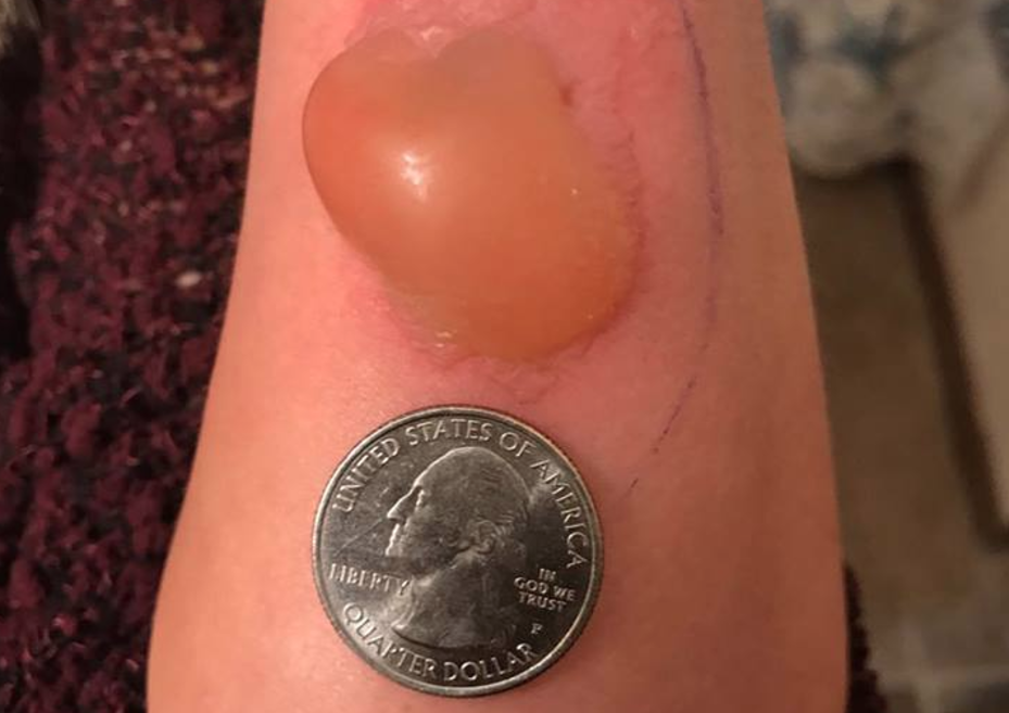 Girl, 9, Thinks Tag Pinched Her, Mom Discovers Brown Recluse Spider Bite  (Exclusive)