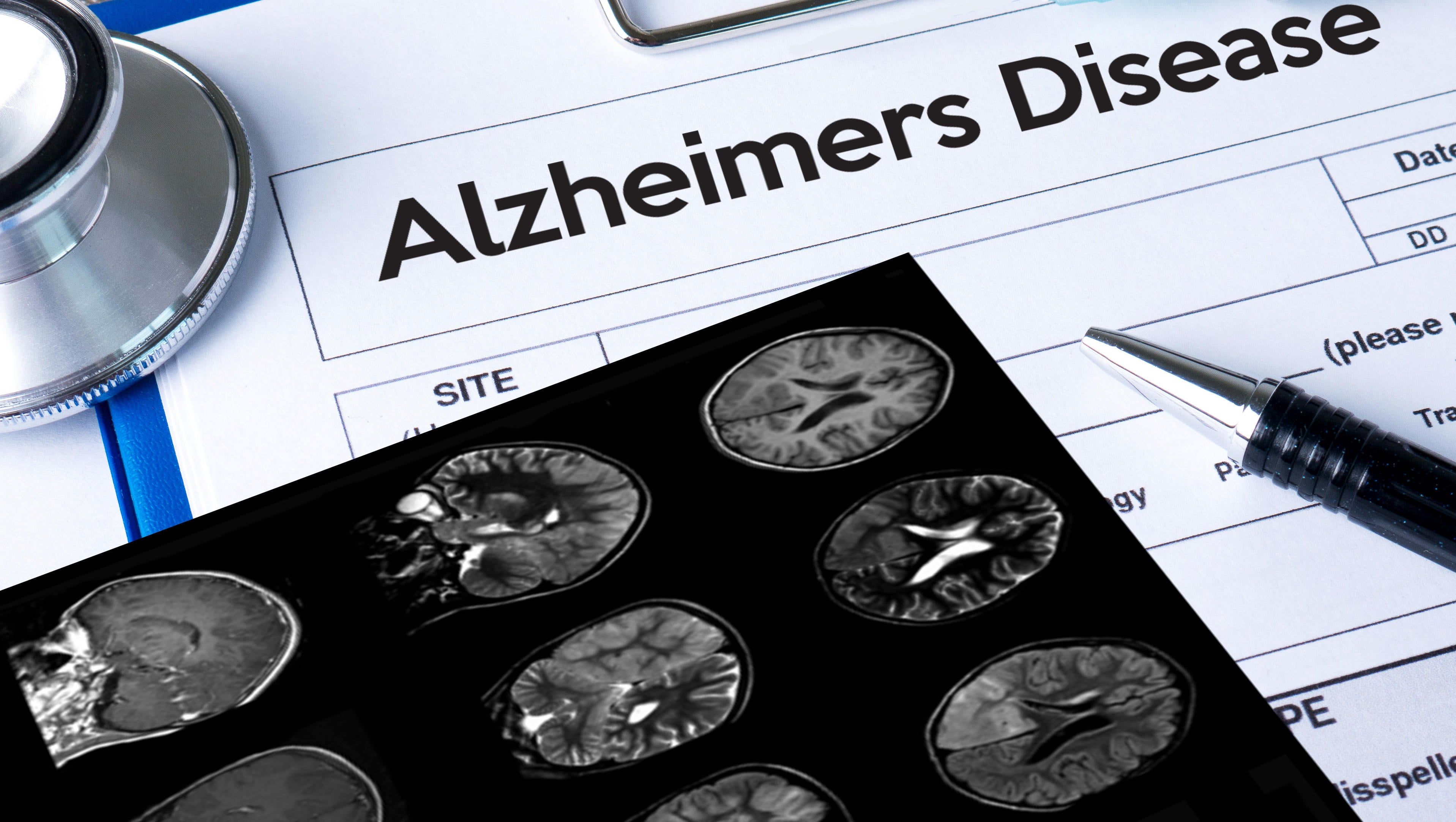 Alzheimer's Deaths Are Skyrocketing, CDC Reports - CBS News