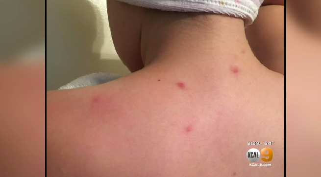 rash-spreads-among-students-teachers-after-rats-invade-calif