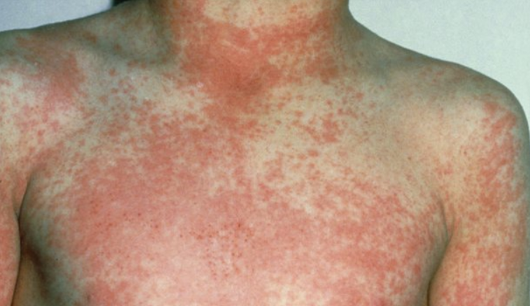 Scarlet Fever: A Deadly History and How it Prevails