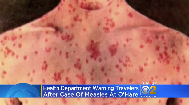 Passenger With Measles May Have Exposed Others At Chicago Airport - CBS ...