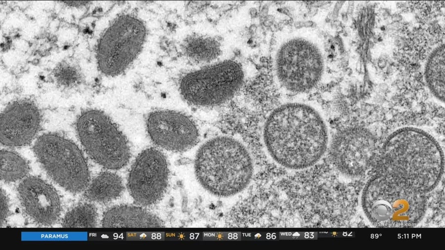 Thousands of monkeypox vaccine doses coming to New York City - CBS New York