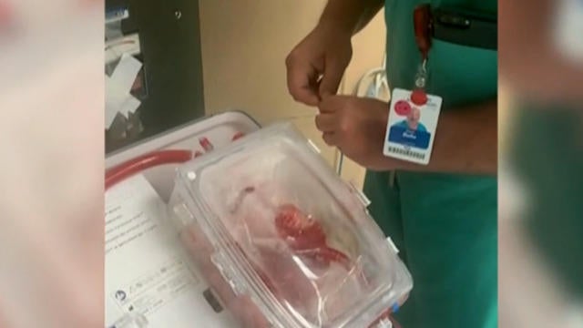 After she was given 24 hours to live, a rare transplant saved her life