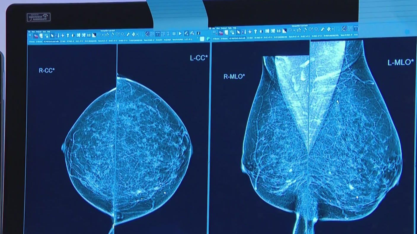 健康・医学 Breast Cancer Breast Cancer: Evaluating Tumor Estrogen Receptor Status