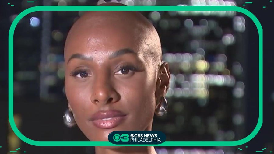 Showing my true self to the world with alopecia: 