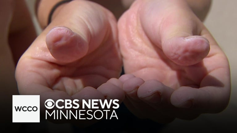 Why does water make our skin wrinkle? - CBS Minnesota