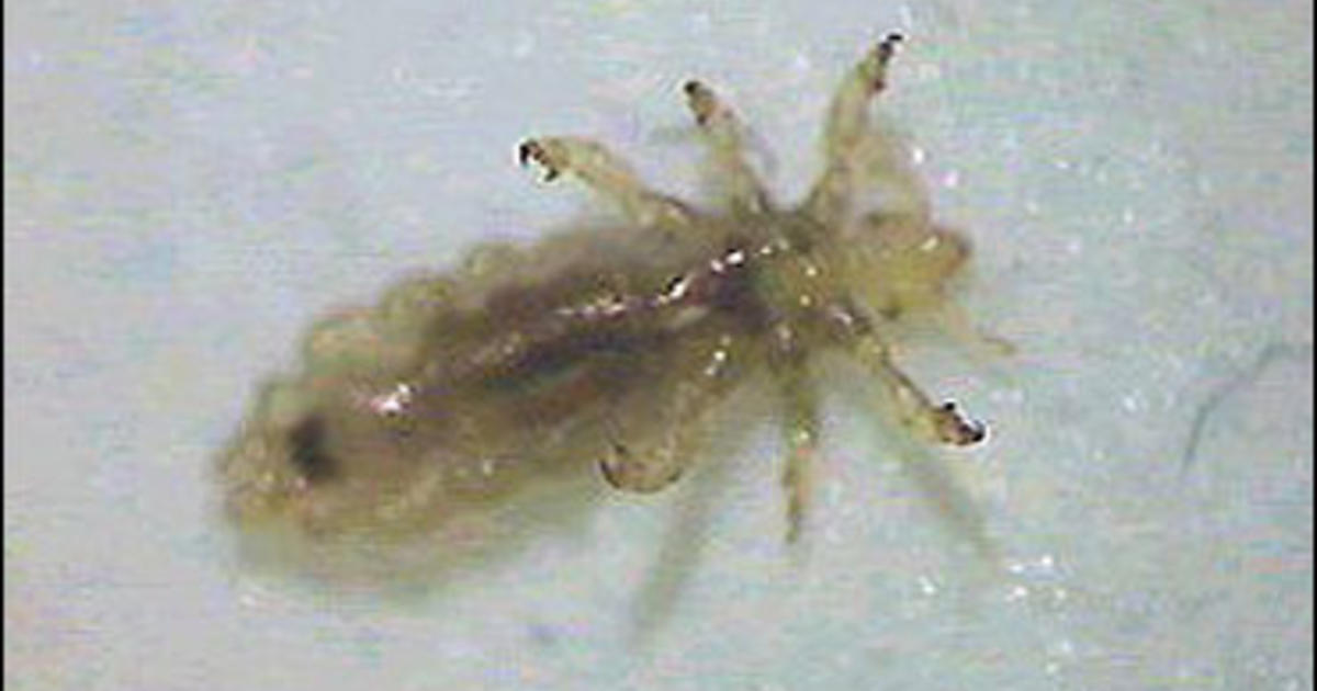 New Hope in Battle to Beat Lice - CBS News