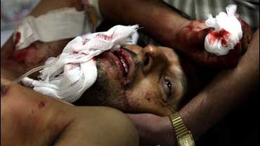 Close up of man's bloodied face in hospital after car bomb 