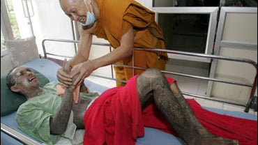 A Thai Buddhist monk talks to an AIDS/HIV patient at Wat Phrabatnampo AIDS hospice in Lopburi province, Thailand, Friday Sept. 25, 2009. Researchers in Thailand reported for the first time an experimental vaccine has prevented infection with the AIDS viru 