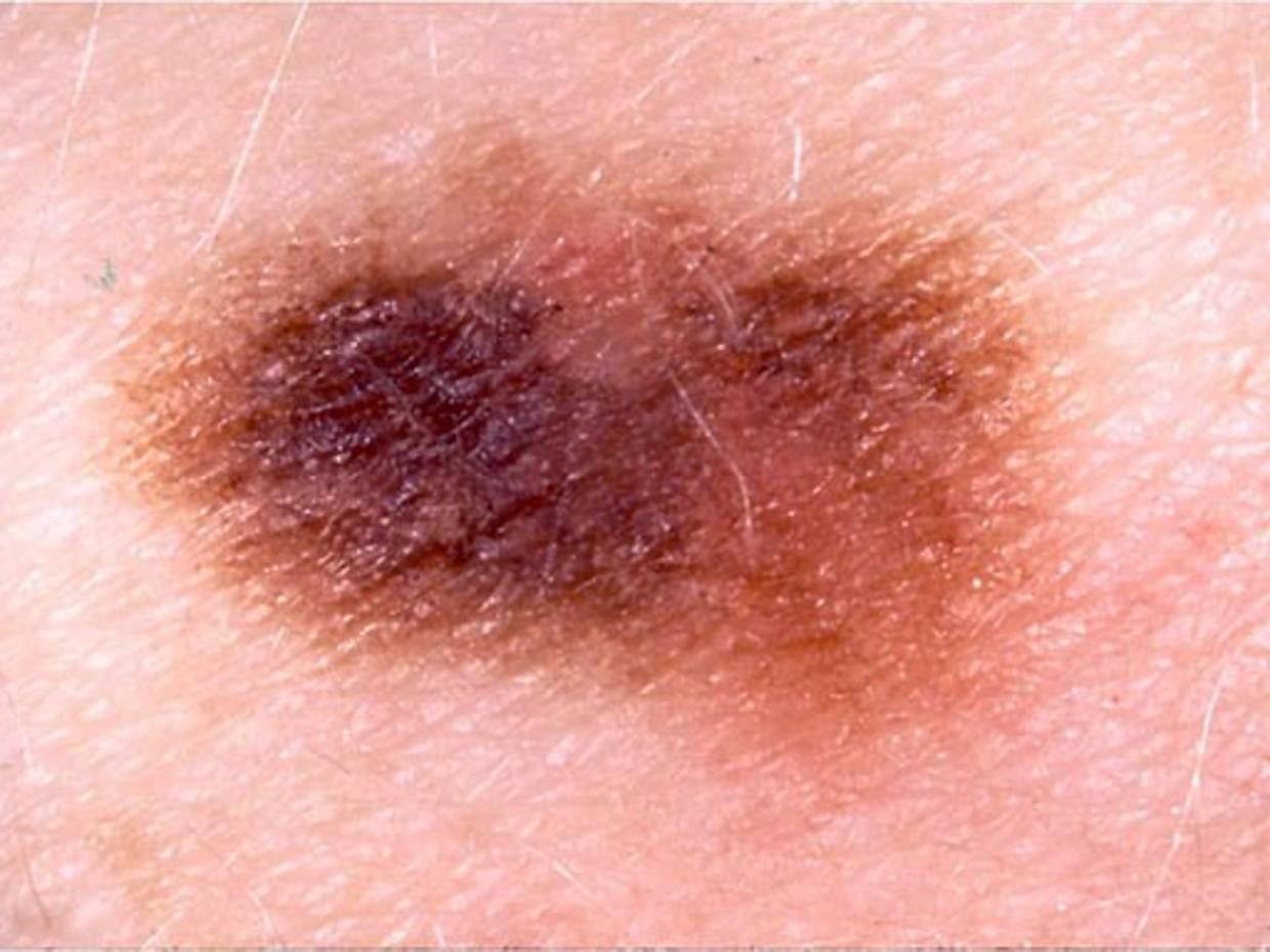 Skin Cancer Or Mole How To Tell