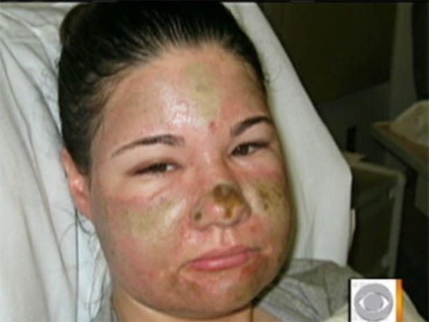 Bethany Storro, 28, after random attack with acid by total stranger in Vancouver, Wash. 