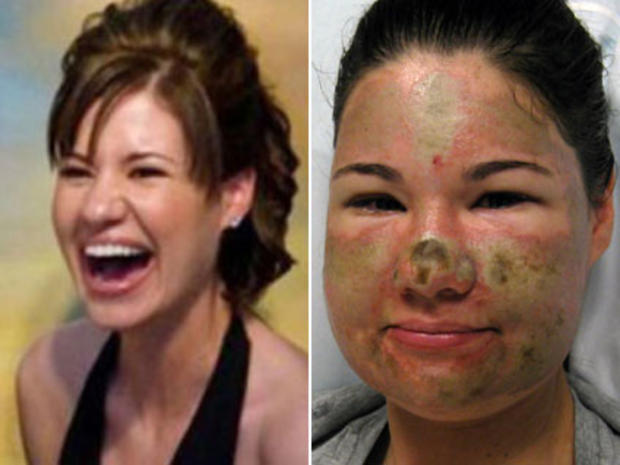 Acid Attack Hoax: Cops Say Bethany Storro Did it to Herself 