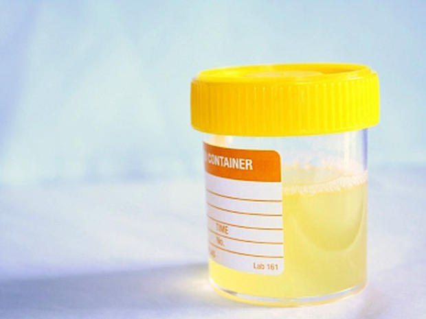 urine sample 