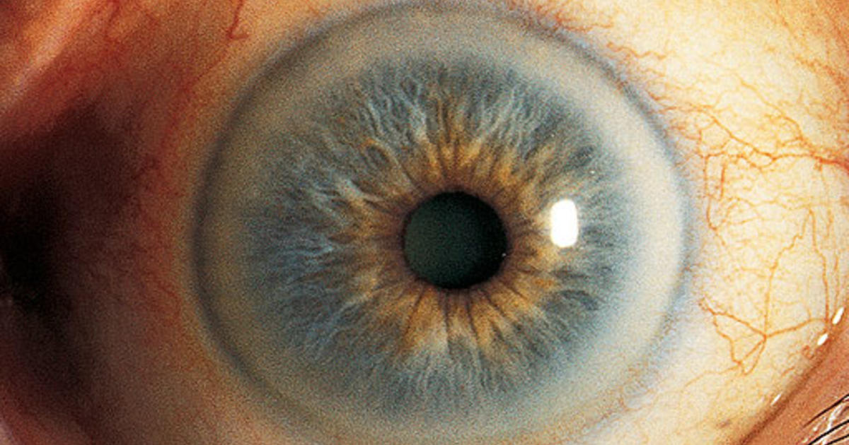 Why Do Some People Have Dark Rings Around the Iris of Their Eye? - Bellatory