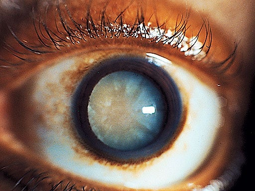 Cataract.jpg