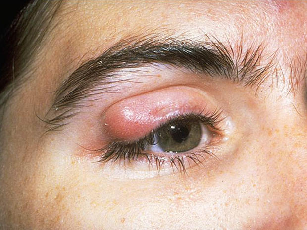 Eyelid-Tumor-upper.jpg 