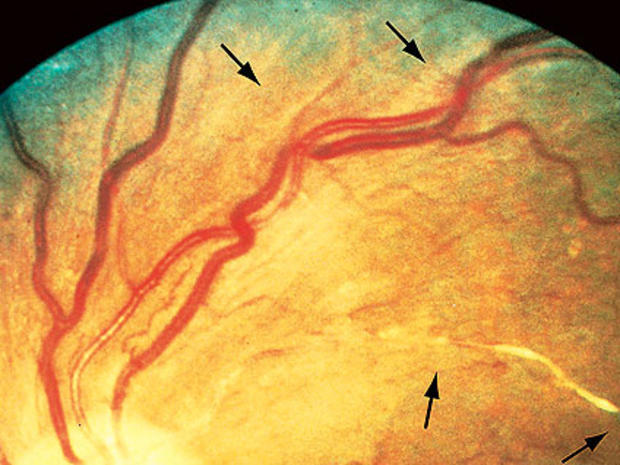 hypertensive-retin-2.jpg 