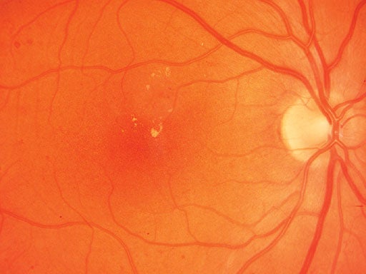 Nonprolifertive-Diabetic-re.jpg