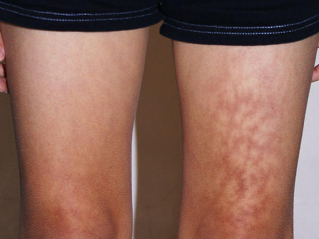 Toasted skin syndrome' is a real condition from the age of wood