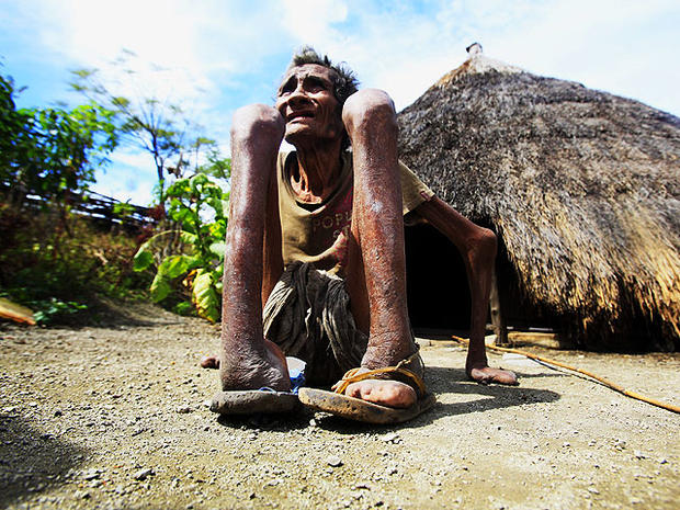 Leprosy is still a threat in parts of Indonesia, where this photo was taken on July 8, 2010. It shows former leprosy  patient Adelino Quelo, 68, crouching outside his hut. His fingers, toes and parts of his hands and feet are missing. (AP Photo/Wong Maye-E) 