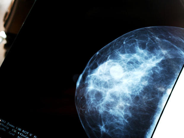 mammogram-4x3_1.jpg 