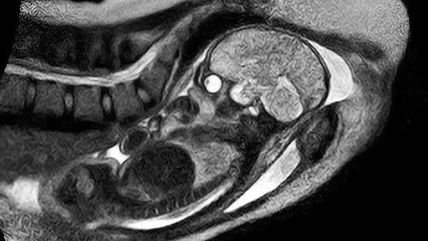 Moment of Birth Captured on MRI 