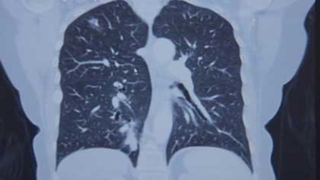 lung.jpg 