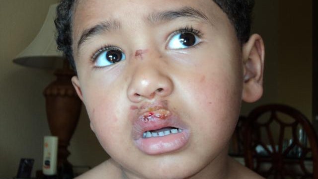 Boy Burned By Nacho Cheese Sues Disney 