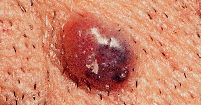 skin-cancer-moles-on-legs