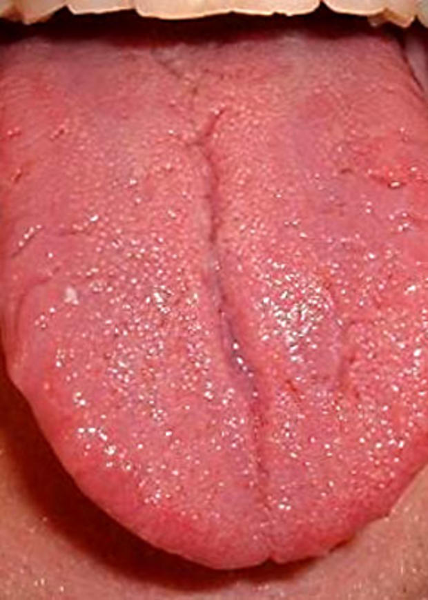 Red-inflammed-tongue.jpg 