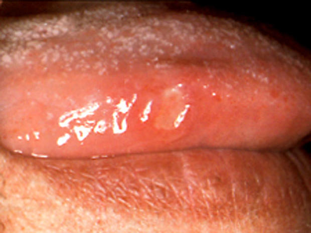 Minor-tongue-lesion_1.jpg 