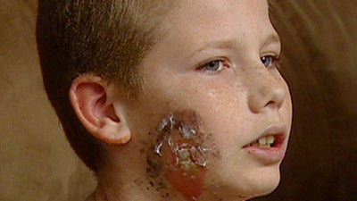 Boy doused with cologne, set on fire at sleepover 