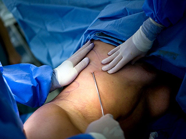 Liposuction_iStock_00001280.jpg 