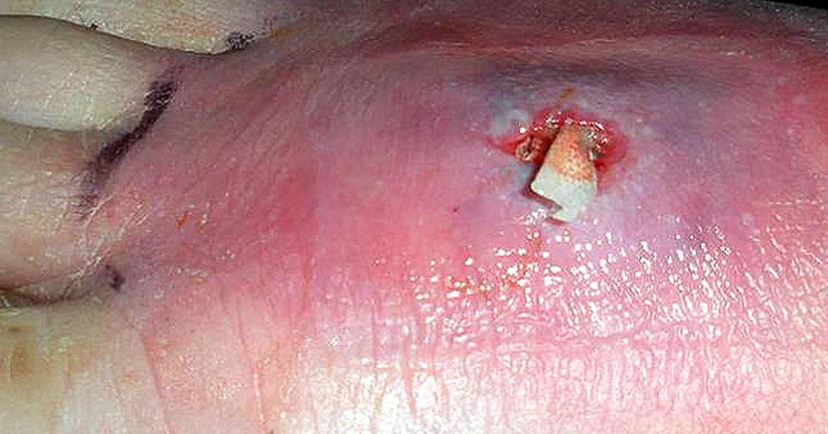 krokodille dome excentrisk Deadly skin infection? 12 graphic photos that could save your life