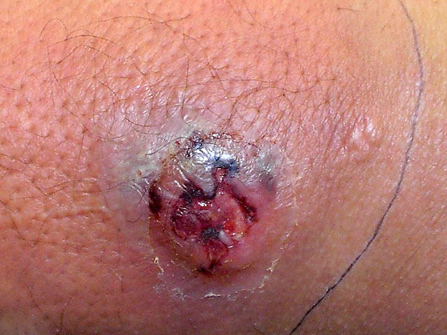 krokodille dome excentrisk Deadly skin infection? 12 graphic photos that could save your life